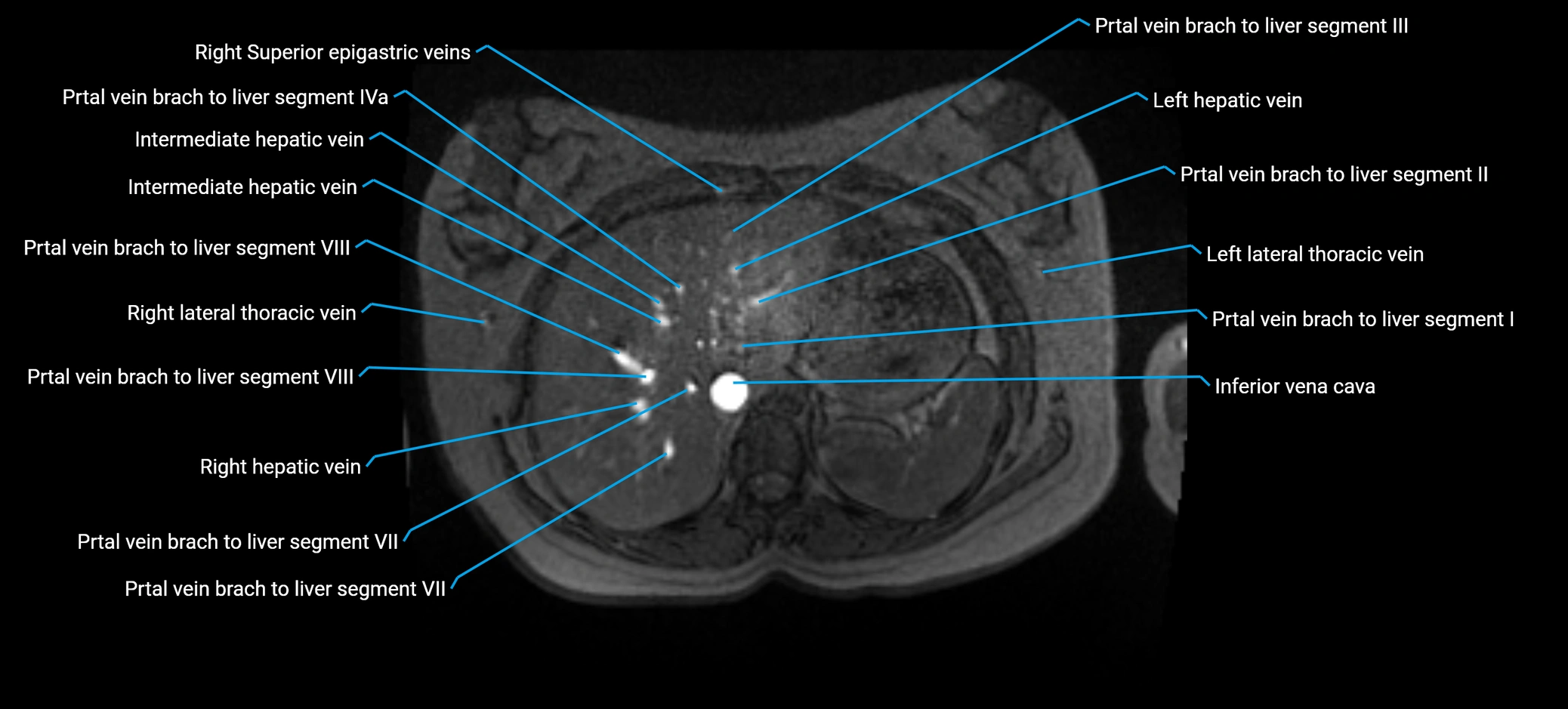 MRV abdomen pelvis & lower limb axial cross sectional anatomy labelled MRI image 33 (1).webp